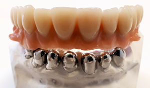 Dentallabor spezialisiert in herausnehmbaren Zahnersatz