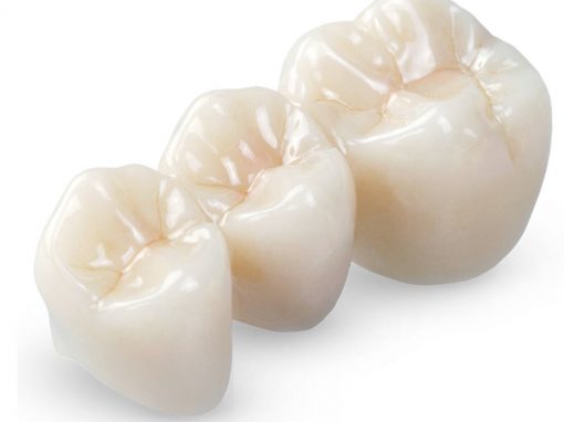 Metallfreie Zahnversorgungen wie Vollzirkonkronen und –brücken aus gefrästem Zirkonoxid