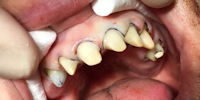Präparation und das Beschleifen der Zähne