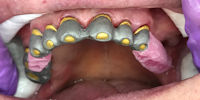 Präparation und das Beschleifen der Zähne