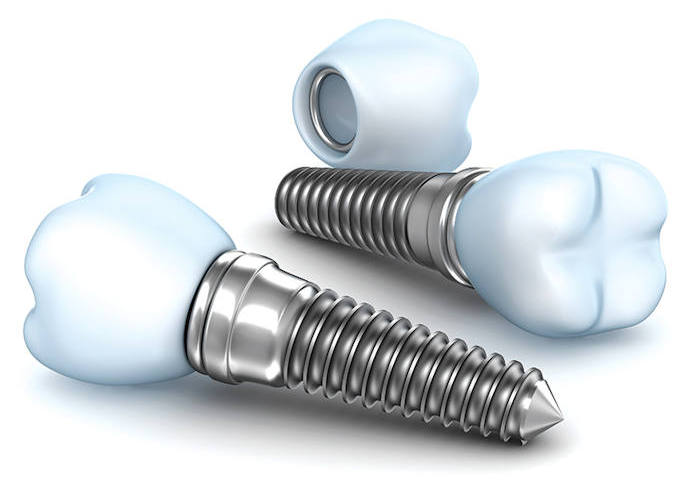 Implantatprothetik: Zahnersatz auf Implantaten