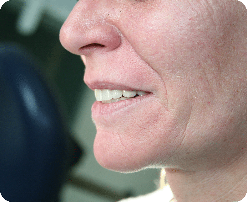 Nahaufnahme einer Frau mit natürlich wirkender Zahnprothese im Seitenprofil – Zahnersatz von Malkodent, der sicher sitzt und echt aussieht