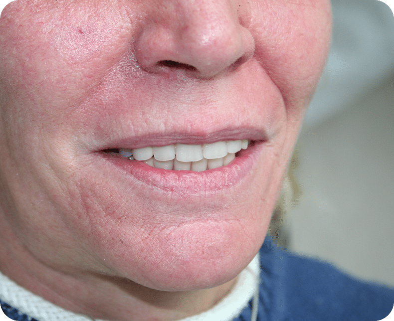 Frau mit realistisch aussehender Zahnprothese lächelt nach Behandlung – Beispiel für ästhetischen Zahnersatz von Malkodent Zahntechnik