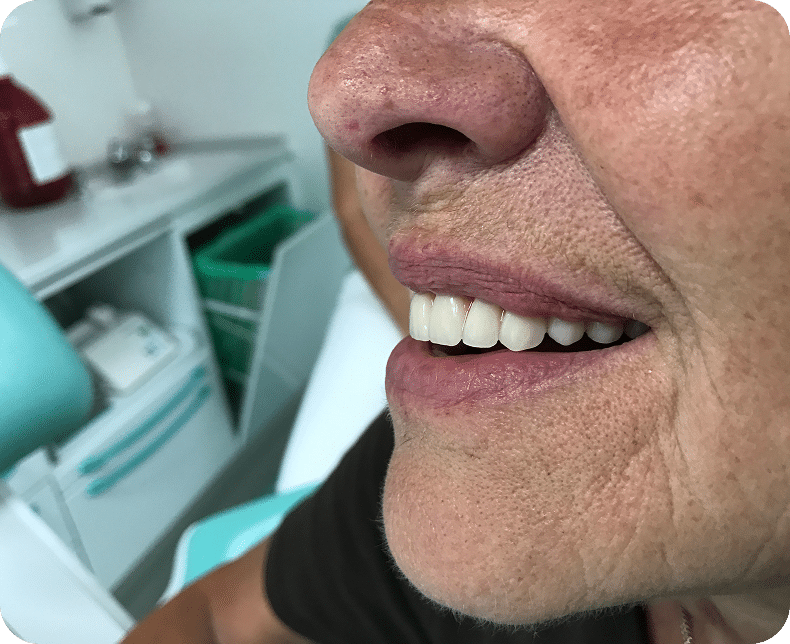 Seitliche Nahaufnahme eines zufriedenen Patienten mit weißem, passgenauem Zahnersatz von Malkodent – natürliches Ergebnis nach Prothesenanpassung