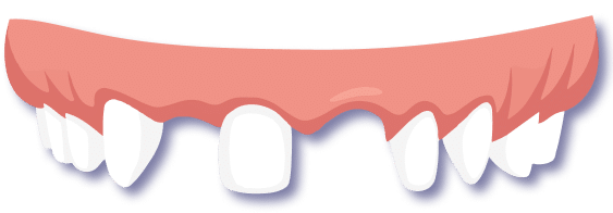 Grafische Darstellung einer Teleskopprothese mit Ober- und Unterkiefer – Zahnersatz ohne Gaumenplatte, leicht herausnehmbar und anpassbar von Malkodent