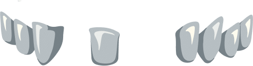 Grafische Darstellung einer Teleskopprothese mit Ober- und Unterkiefer – Zahnersatz ohne Gaumenplatte, leicht herausnehmbar und anpassbar von Malkodent