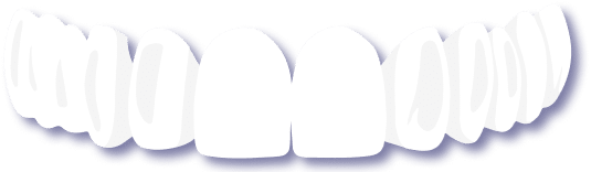 Grafische Darstellung einer Teleskopprothese mit Ober- und Unterkiefer – Zahnersatz ohne Gaumenplatte, leicht herausnehmbar und anpassbar von Malkodent