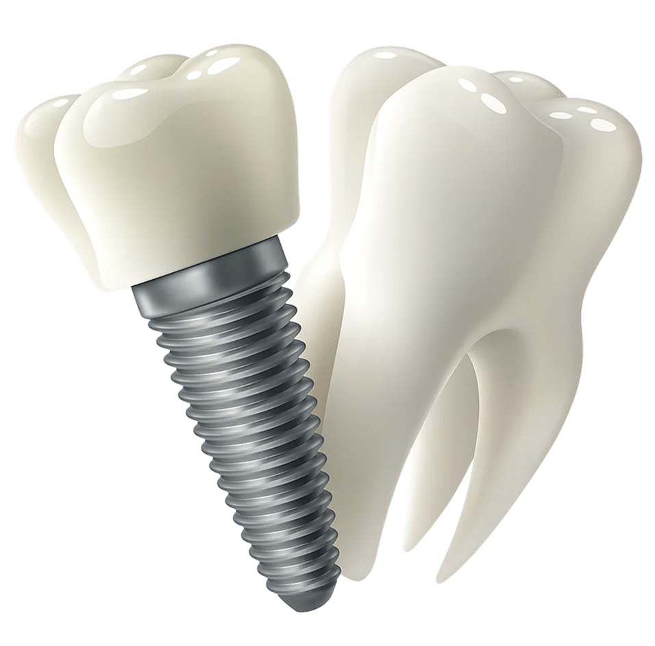 3D-Darstellung eines Zahnimplantats mit Krone, das wie ein echter Zahn aussieht – Zahnersatz von Malkodent Zahntechnik